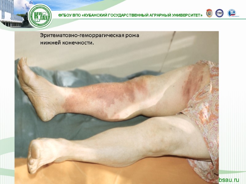 Эритематозно-геморрагическая рожа нижней конечности.